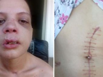 20χρονη Βουλγάρα δείχνει τα τραύματα που υπέστη από εμπόρους λευκής σαρκός στην χώρα της