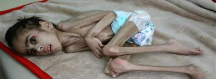 Υεμένη: Θλίψη προκαλεί η εικόνα υποσιτισμένου 7χρονου παιδιού που ζυγίζει μόλις 7 κιλά!