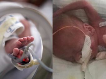 Γενέθλια για το «πιο πρόωρο μωρό του κόσμου»: Είχε 0% πιθανότητες να ζήσει