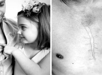 Πατέρας έκανε τατουάζ ίδιο με την ουλή της κόρης του για να της συμπαρασταθεί