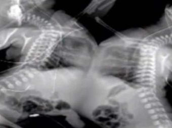 27χρονη έγκυος πήγε να κάνει υπερηχογράφημα – Όταν το είδαν οι γιατροί πάγωσαν και της είπαν να το ρίξει (Video)