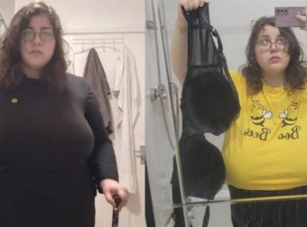 «Το στήθος μου ζυγίζει 12 κιλά, χρειάζομαι μπαστούνι»: 22χρονη με γιγαντομαστία κινδυνεύει να μείνει ανάπηρη