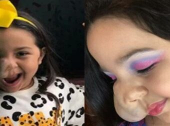 «Μαμά, Είμαι Άσχημη»: Μητέρα πείθει την 6χρονη κόρη της με όγκο στο πρόσωπο πως είναι πανέμορφη