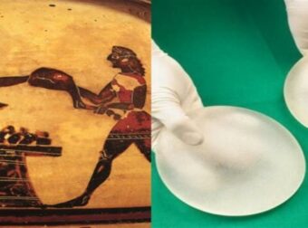Προσθετική στήθους στην Αρχαία Ελλάδα: Κι όμως οι Αρχαίες Ελληνίδες έβαζαν εμφυτεύματα στα στήθη τους