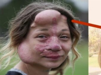 Όσο μεγάλωνε το πρόσωπό της αλλοιωνόταν και οι γιατροί αποφάσισαν να της κόψουν την μύτη…Η εικόνα της σήμερα σοκάρει!