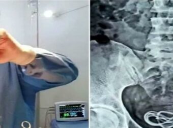 30χρονος πήγε στο νοσοκομείο με αφόρητους πόνους στην κοιλιά – Άφωνος ο γιατρός μόλις είδε την ακτινογραφία (photo)