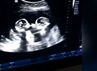28χρονη έγκυος πήγε στον γυναικολόγο για υπέρηχο – Όταν όμως ο γιατρός είδε τι συμβαίνει μέσα στην κοιλιά της «πάγωσε» (Video)