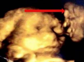 Αυτή η έγκυος όταν πήγε για υπέρηχο περίμενε να δει το μωρό της – Ποιος ήταν όμως αυτός που φαίνεται να φιλάει το μωρό;
