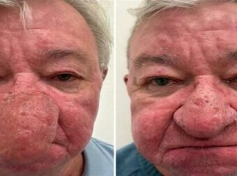 Απίστευτη μεταμόρφωση: Το σπάνιο πρόβλημα υγείας που μεγάλωνε τη μύτη ενός 68χρονου