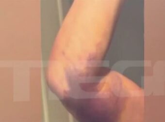 Γιώργος Μαζωνάκης: Σοκάρει βίντεο με την γιατρό από την πλασμαφαίρεση σε άλλη ασθενή – «Μπρος στα κάλλη τι είναι ο πόνος;»